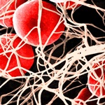 Haemophilia A